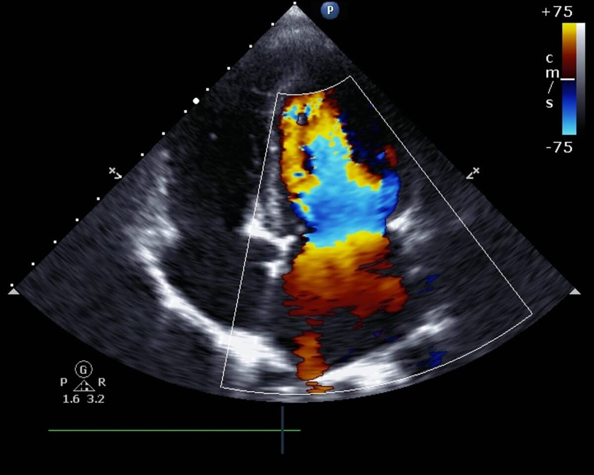 Transthoracic two-dimensional color Doppler echocardiography